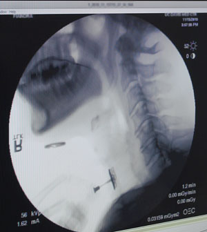 X-ray with swallow device inserted in patient's throat © UC Regents