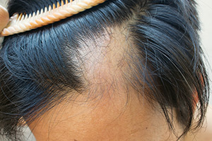 Hair Disorders DOJ Photo