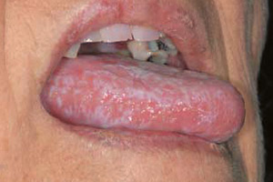 Oral Mucosal DOJ Photo