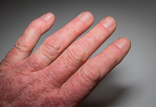 A close-up photo of a person’s left hand with red blisters on the skin and swollen fingers