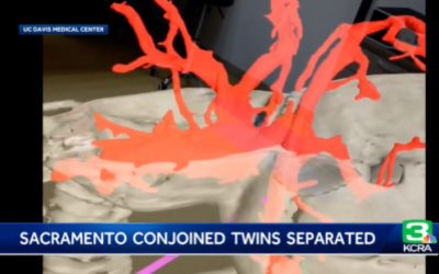 vasculature of the conjoined twins