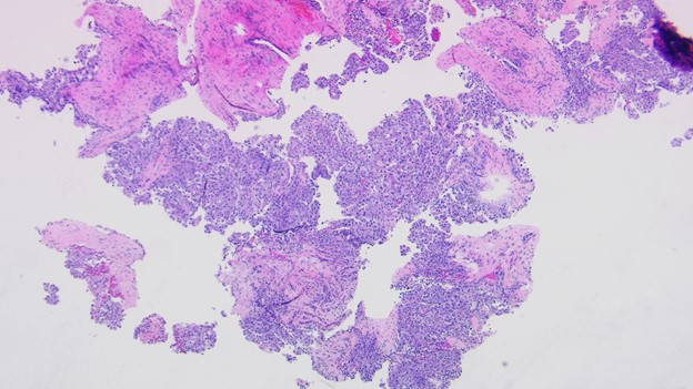 Liver, right lobe mass biopsy 40x