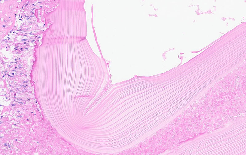 Acellular laminated eosinophilic layer