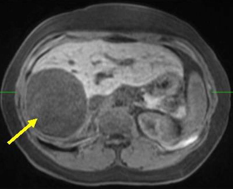 MRI shows the large liver cyst