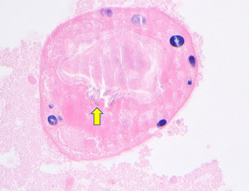 partially calcified scolex