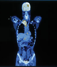 PHOTO —  PET-CT of a male torso. Tissues that burn more glucose, including the brain and bladder, appear yellow. Cancerous tissue also lights up. In this image, a large tumor can be seen just below the neck, toward the patient's right shoulder.
