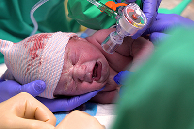 A newborn child after its birth with doctors and nurses holding it.