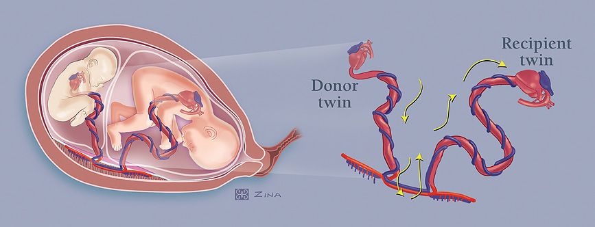 Illustration of Twin-to-twin transfusion syndrome