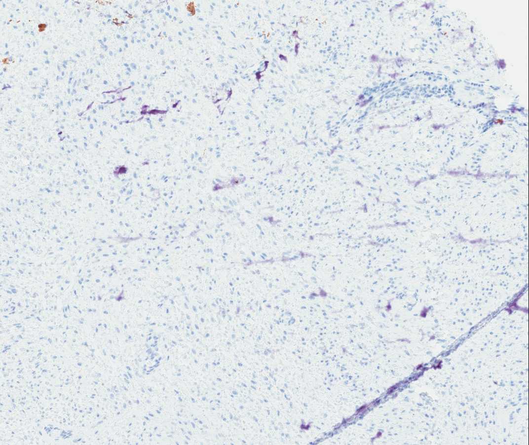 Case of the Month, Aug. 2012: Immunohistochemistry images - Figure 9