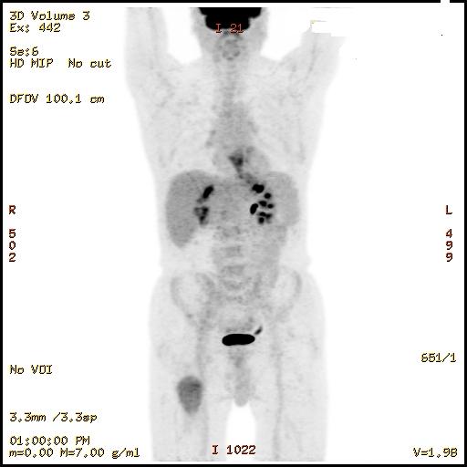 Case of the Month, Mar. 2013: PET Scan