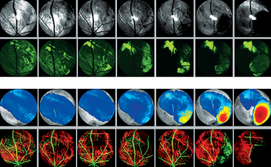 These images show glioblastoma cells growing under the retina of a mouse eye using two different kinds of optical scanning technologies. The first and second rows show reflected and fluorescent light. In the third row tumor thickness is color coded, with red representing the greatest thickness. The fourth row images blood vessels, with green showing the anterior retinal vessels and the red the posterior choroidal vessels.